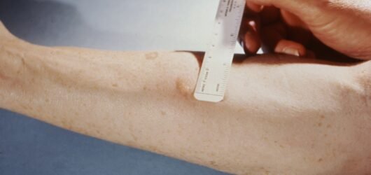 Como Fazer o Teste de Sensibilidade (Patch Test) em Cosméticos