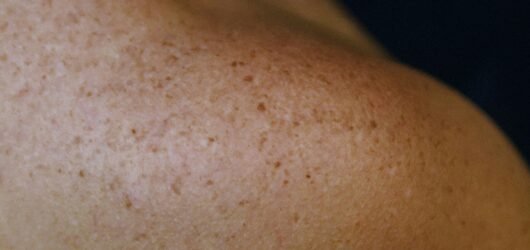 Melasma x Manchas de Sol: Você Sabe a Diferença?